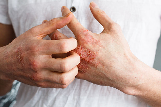 eczema atopic dermatitis