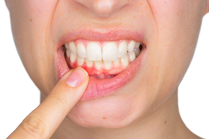 Gingivitis Gum Disease