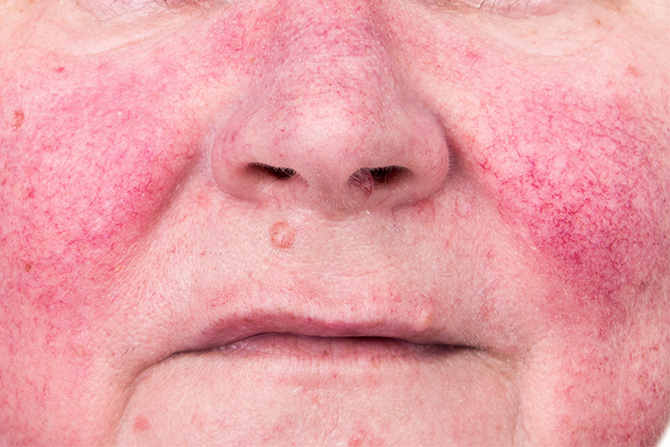 rosacea face rash