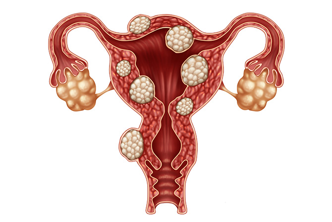 uterine fibroids diagram