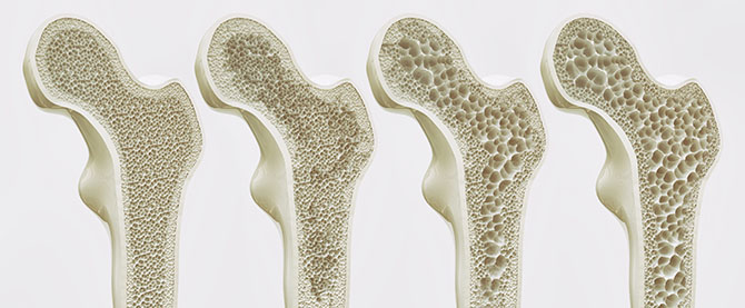 osteoporosis bone loss