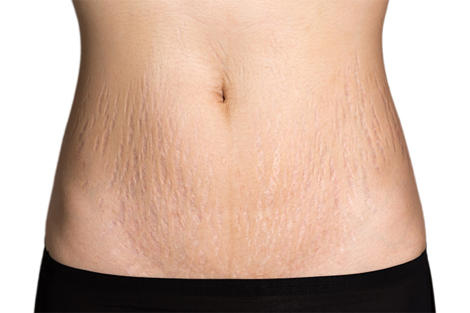 stretch marks abdomen waist