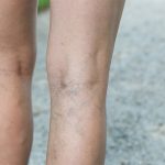 spider varicose veins legs
