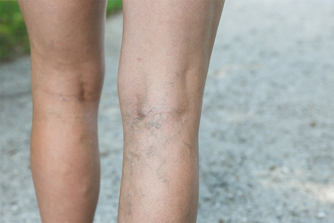 spider varicose veins legs