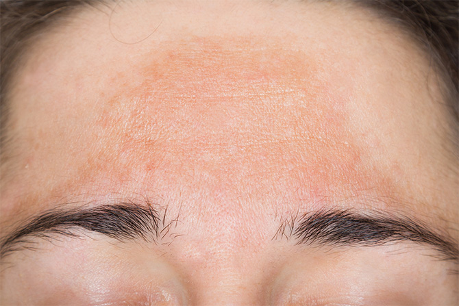 melasma skin hyperpigmentation brown sun spots forehead
