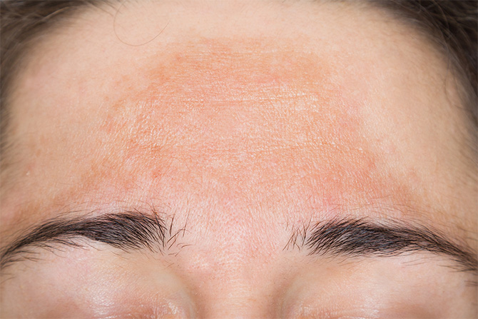 Dark Spots on Face (Melasma): Causes and Treatment